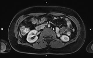 Bilateral adrenal myelolipoma (Radiopaedia 63058-71537 G 53).jpg