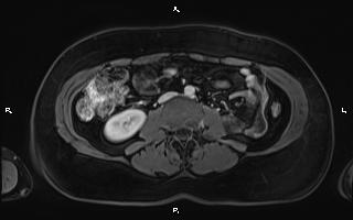 Bilateral adrenal myelolipoma (Radiopaedia 63058-71537 G 63).jpg