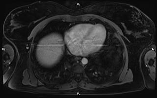 Bilateral adrenal myelolipoma (Radiopaedia 63058-71537 G 8).jpg