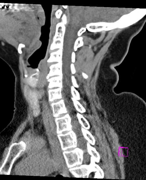 Bilateral atlanto-occipital assimilation (Radiopaedia 28350-28603 D 36).jpg