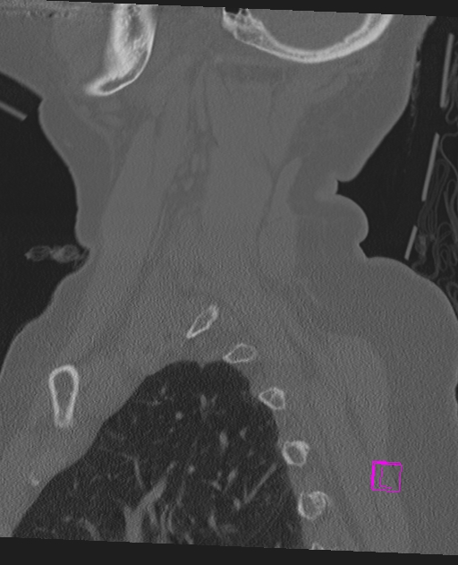Bilateral atlanto-occipital assimilation (Radiopaedia 28350-28603 Sagittal bone window 65).jpg