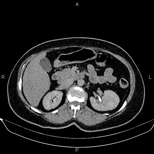 Bilateral benign adrenal adenomas (Radiopaedia 86912-103124 Axial C+ delayed 49).jpg