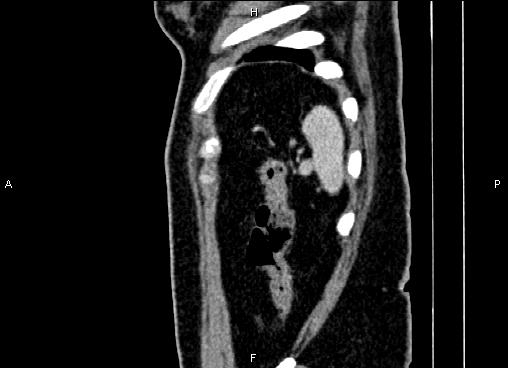 Bilateral benign adrenal adenomas (Radiopaedia 86912-103124 E 92).jpg