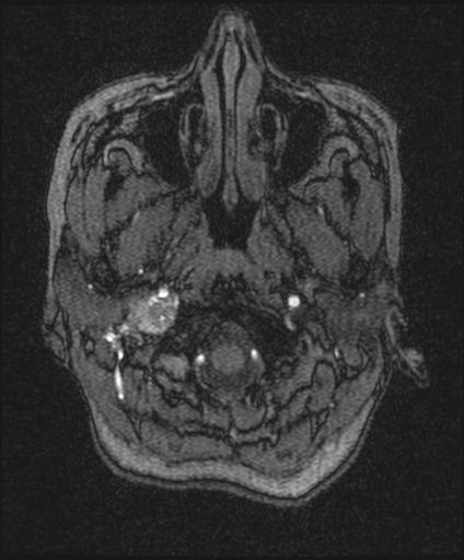 Bilateral carotid body tumors and right glomus jugulare tumor (Radiopaedia 20024-20060 Axial MRA 13).jpg