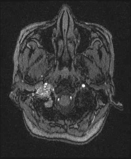 Bilateral carotid body tumors and right glomus jugulare tumor (Radiopaedia 20024-20060 Axial MRA 19).jpg