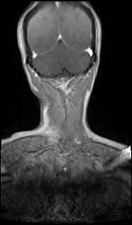 Bilateral carotid body tumors and right glomus jugulare tumor (Radiopaedia 20024-20060 MRA 69).jpg
