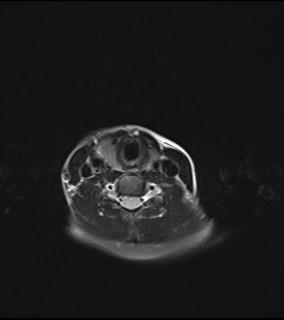 File:Bilateral carotid body tumors and right jugular paraganglioma (Radiopaedia 20024-20060 Axial 46).jpg