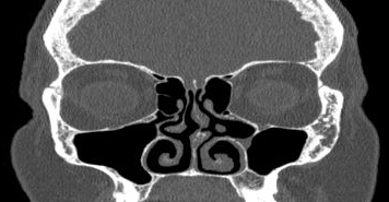 File:Bilateral ectopic infraorbital nerves (Radiopaedia 49006-54084 Coronal 41).png