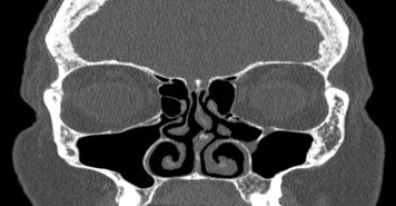 File:Bilateral ectopic infraorbital nerves (Radiopaedia 49006-54084 Coronal 42).png