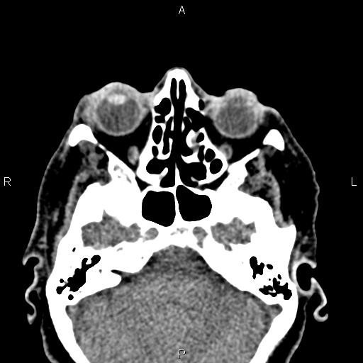 File:Bilateral enlargement of lacrimal glands - sarcoidosis (Radiopaedia 62627-70921 Axial non-contrast 34).jpg
