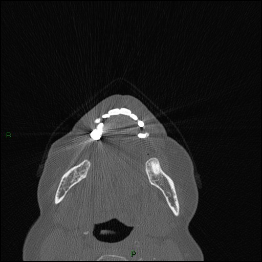 Bilateral frontal mucoceles (Radiopaedia 82352-96454 Axial bone window 294).jpg