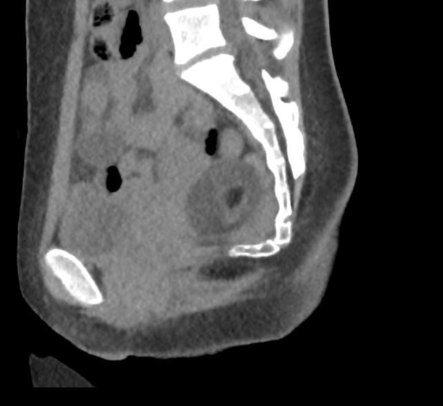 Bilateral mature cystic ovarian teratoma (Radiopaedia 88821-105592 D 35).jpg