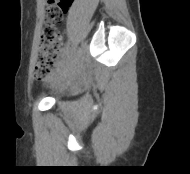 Bilateral mature cystic ovarian teratoma (Radiopaedia 88821-105592 D 7).jpg
