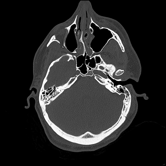 Bilateral occipital condyle fracture (type 2) (Radiopaedia 87675-104089 Axial bone thins 69).jpg