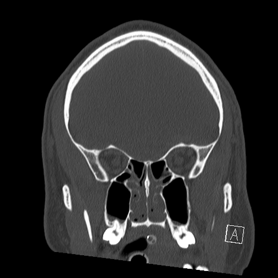 Bilateral occipital condyle fracture (type 2) (Radiopaedia 87675-104089 Coronal bone window 26).jpg