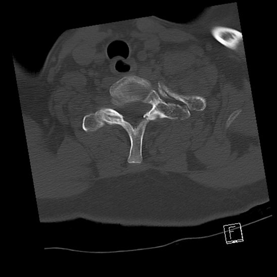 Bilateral occipital condyle fractures (type 3) (Radiopaedia 87672-104086 Axial bone window 67).jpg