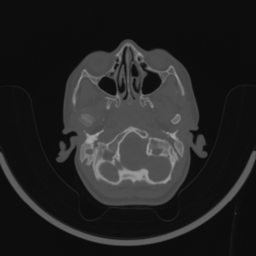 Bilateral otosclerosis (Radiopaedia 57237-64157 C 15).jpg