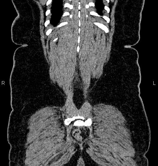 Bilateral ovarian dermoid cysts (Radiopaedia 85785-101603 C 57).jpg