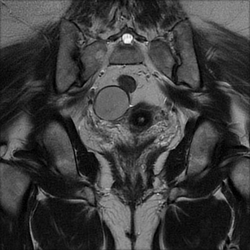 File:Bilateral ovarian dermoid cysts (Radiopaedia 90152-107338 Coronal T2 19).jpg