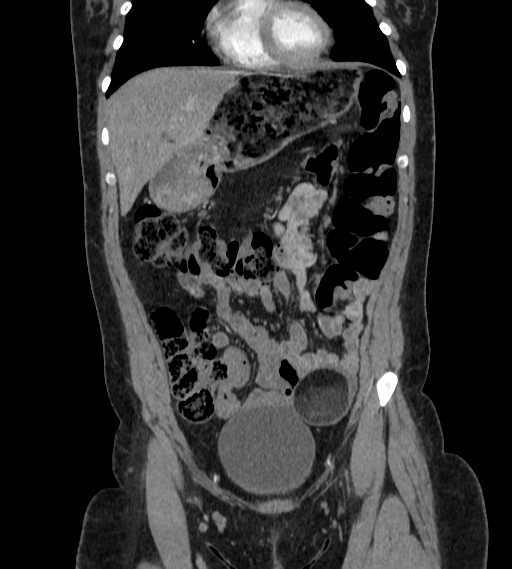 Bilateral ovarian mature cystic teratomas (Radiopaedia 79373-92457 B 11).jpg