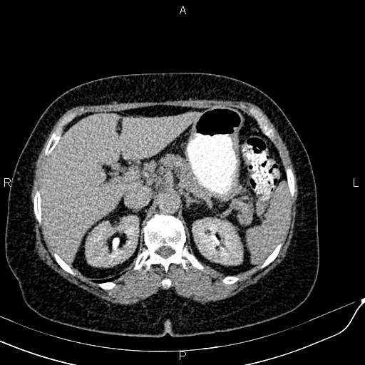 Bilateral ovarian serous cystadenocarcinoma (Radiopaedia 86062-101989 Axial C+ delayed 12).jpg
