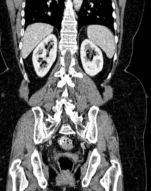 Bilateral ovarian serous cystadenocarcinoma (Radiopaedia 86062-101989 D 38).jpg