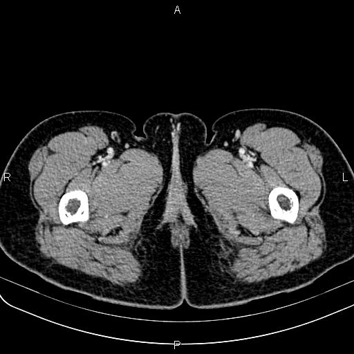 Bilateral ovarian teratoma (Radiopaedia 83131-97503 Axial With contrast 97).jpg