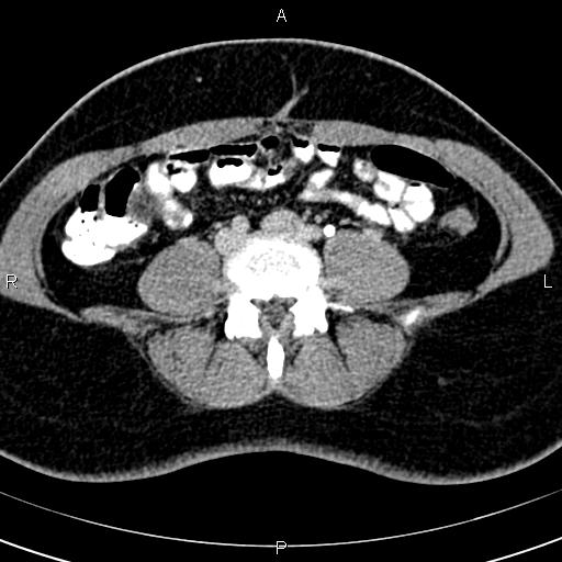 File:Bilateral ovarian teratoma (Radiopaedia 83131-97503 B 1).jpg