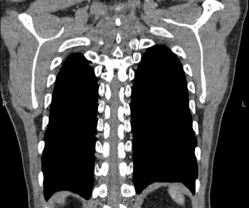 File:Bilateral pulmonary AVM (Radiopaedia 83134-97505 C 63).jpg