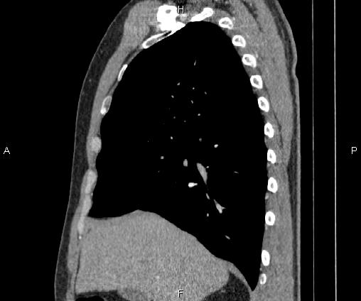 Bilateral pulmonary AVM (Radiopaedia 83134-97505 D 42).jpg