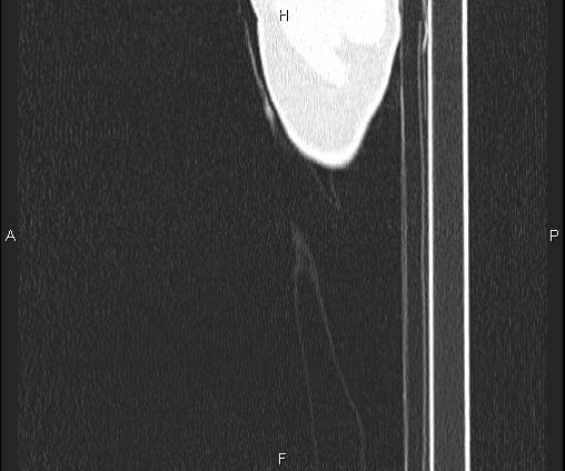 File:Bilateral pulmonary AVM (Radiopaedia 83134-97505 Sagittal lung window 123).jpg