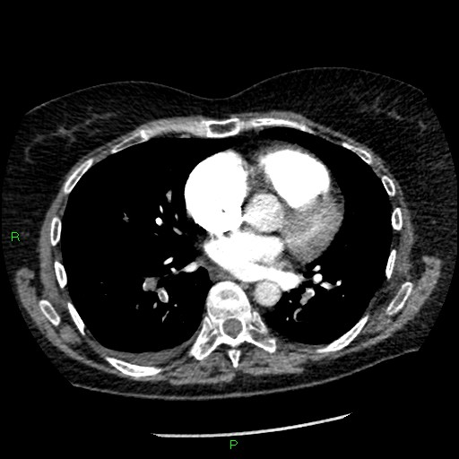 File:Bilateral pulmonary emboli (Radiopaedia 32700-33669 Axial C+ CTPA 63).jpg
