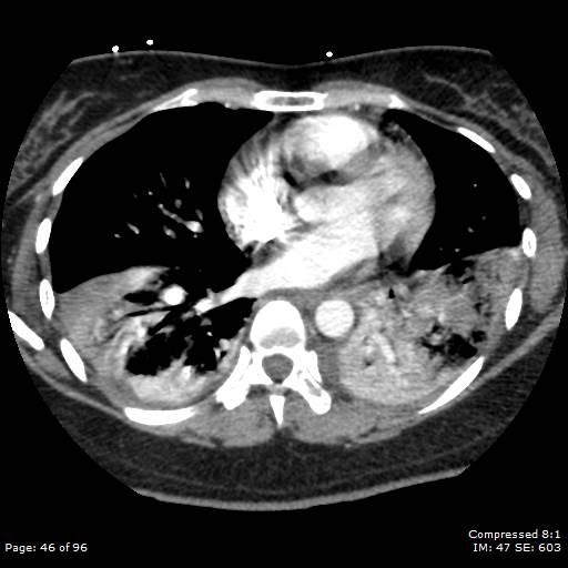 File:Bilateral pulmonary emboli with Hampton hump sign (Radiopaedia 54070-60246 Axial C+ CTPA 43).jpg