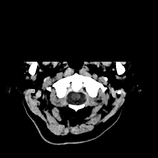File:Bilateral subacute subdural hematoma (Radiopaedia 69240-79018 Axial non-contrast 1).jpg