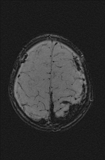 File:Bilateral subdural hemorrhage and parietal skull fracture (Radiopaedia 26058-26190 Axial SWI 69).png
