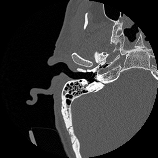 File:Bilateral temporal bone fractures (Radiopaedia 29482-29970 Axial non-contrast 2).jpg