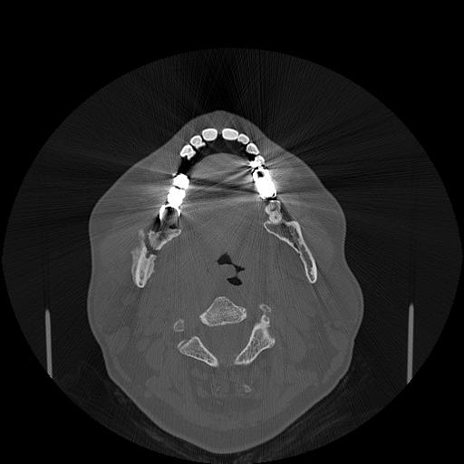 File:Bisphosphonate-related osteonecrosis of the jaw (Radiopaedia 71324-81642 Axial bone window 75).jpg