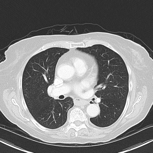 File:Bladder and bowel cancers (Radiopaedia 37688-39592 Axial lung window 27).png