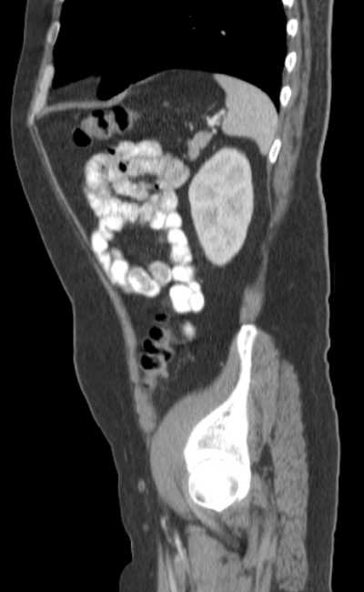 Bleeding duodenal ulcer and adenomyomatosis of gallbladder (Radiopaedia 61834-69861 C 80).jpg