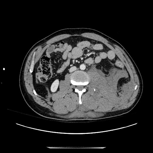 Blunt abdominal trauma with solid organ and musculoskelatal injury with active extravasation (Radiopaedia 68364-77895 A 75).jpg