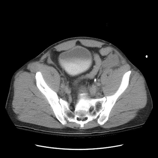 Blunt abdominal trauma with solid organ and musculoskelatal injury with active extravasation (Radiopaedia 68364-77895 Axial C+ delayed 111).jpg