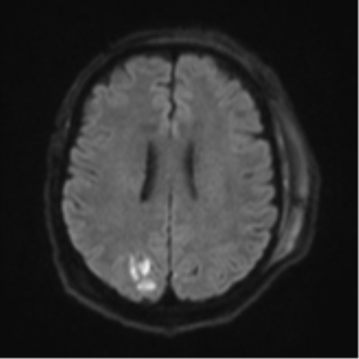Blunt cerebrovascular injury (Radiopaedia 53682-59745 Axial DWI 50).png