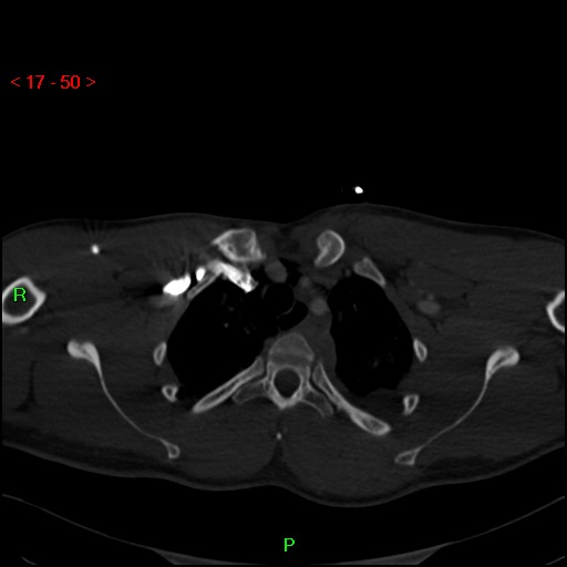 Blunt thoracic trauma (Radiopaedia 73454-84221 Axial bone window 20).jpg