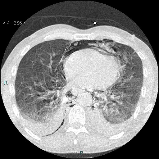 Boerhaave syndrome (Radiopaedia 27683-27897 lung window 66).jpg