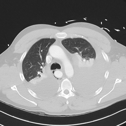 Boerhaave syndrome (Radiopaedia 39382-41661 Axial lung window 19).png