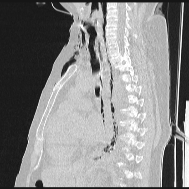 Boerhaave syndrome (Radiopaedia 45644-49799 Sagittal lung window 39).jpg
