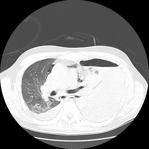 Boerhaave syndrome (Radiopaedia 59796-67310 Axial lung window 29).jpg