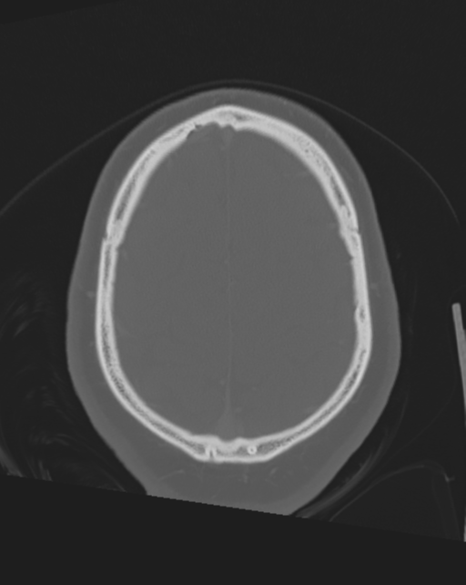 Bone-anchored hearing aid (Radiopaedia 38708-40866 Axial bone window 16).png