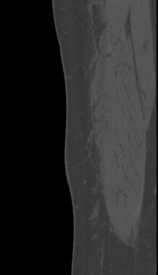 Bone metastasis - tibia (Radiopaedia 57665-64609 Sagittal bone window 16).jpg