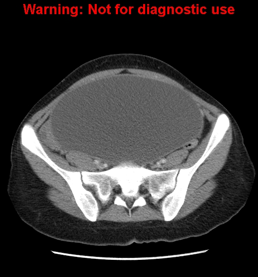 Borderline mucinous cystadenoma of ovary (Radiopaedia 25586-25767 A 74).jpg
